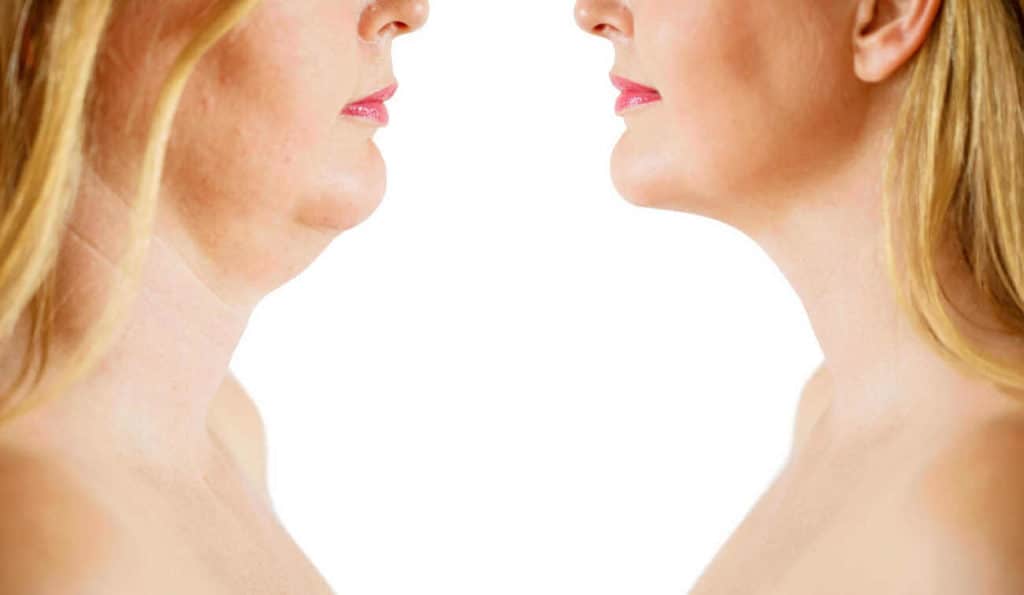 Double Chin treatment West Bromwich before and after results
