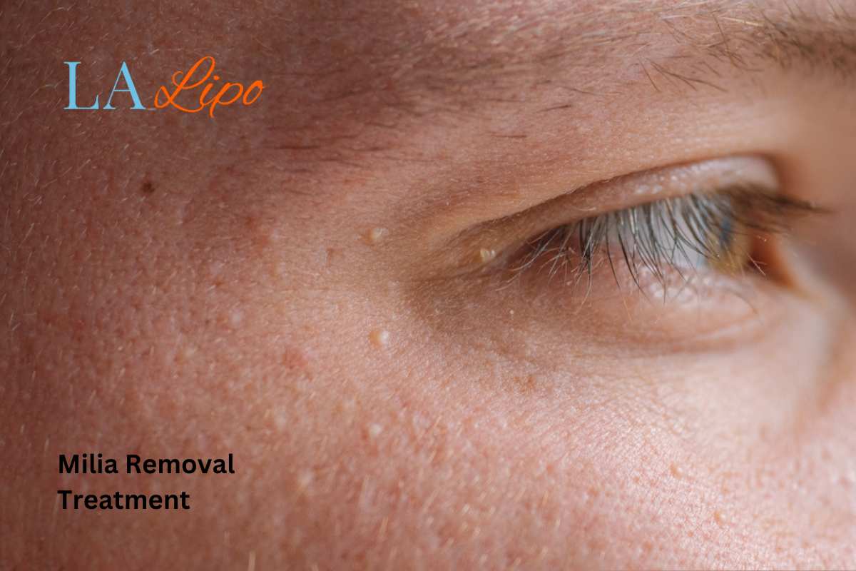 Cryopen Milia Removal: Is It the Easiest and Safest Option West Bromwich?
