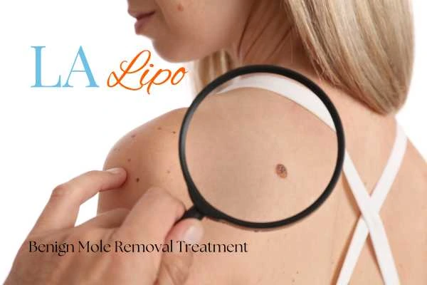 Why getting moles removed West Bromwich can boost your confidence!