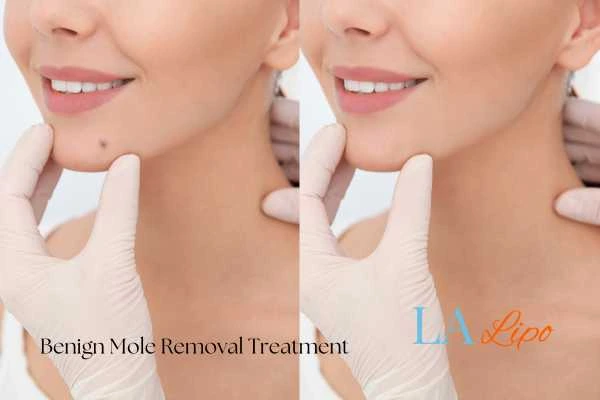 woman's before and after mole removal West Bromwich results