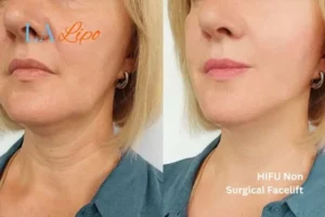 hi-fu for wrinkles West Bromwich before and after results