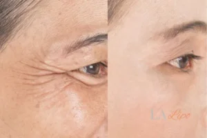 Before and after results of woman - HI-fu wrinkles reduction treatment West Bromwich