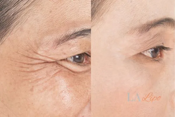 Before and after results of woman - HI-fu wrinkles reduction treatment West Bromwich
