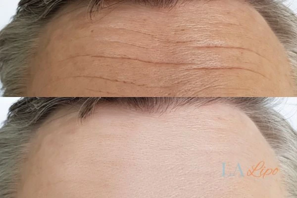 results of HIFU West Bromwich on mans forehead to help reduce lines and wrinkles