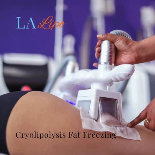 fat freezing - Cryolipolysis West Bromwich