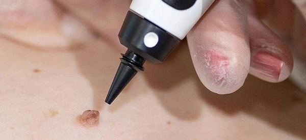 skin tag removal using cryopen West Bromwich