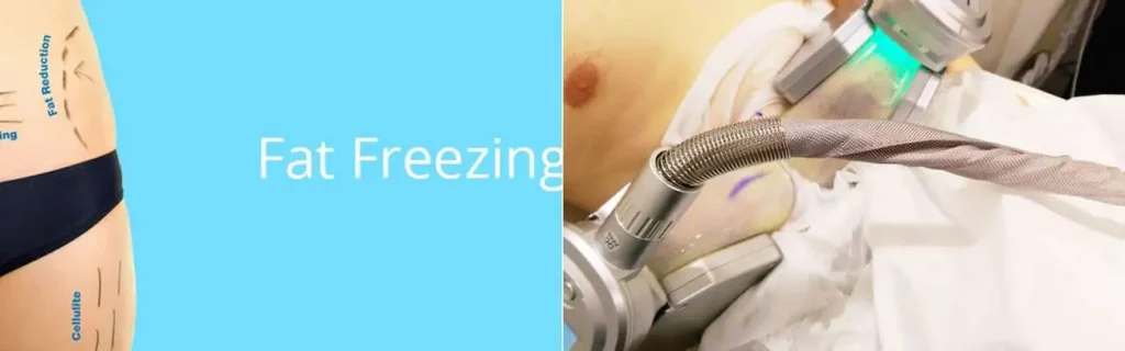 Fat freezing West Bromwich on multiple areas of the body