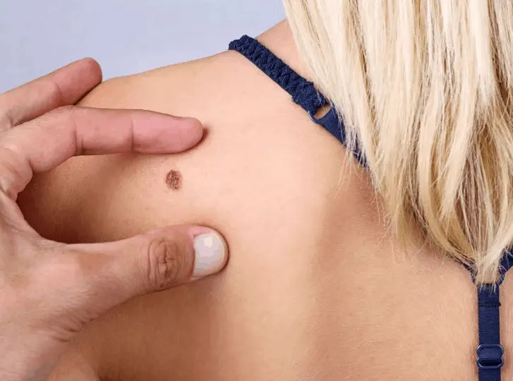 woman having mole removal West Bromwich consultation before treatment.