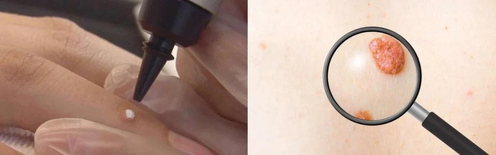Person getting moles removed with cryopen West Bromwich