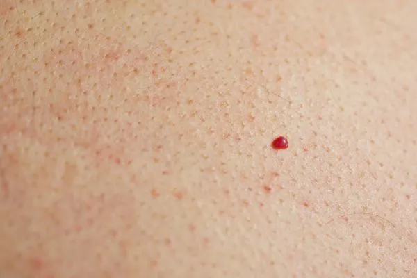 close up of a cherry angioma West Bromwich
