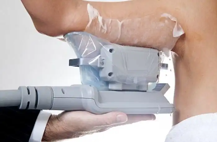Picture of fat freezing West Bromwich on the upper arms.