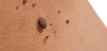 image of a skin tag West Bromwich