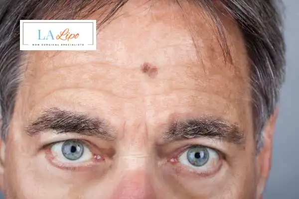 Solar Lentigo Removal West Bromwich image of man with mark on his forehead