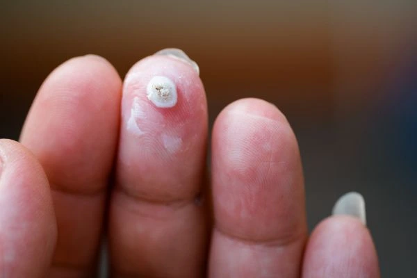 wart on person finger - cryotherapy to treat from LA LIPO West Bromwich