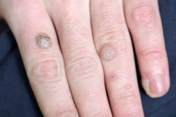 photo of warts on person hand - see wart removal West Bromwich from LA LIPO