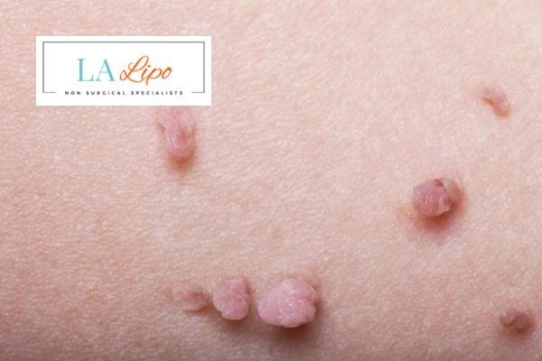 Does cryopen skin tag removal West Bromwich hurt? Find out now call our team today!