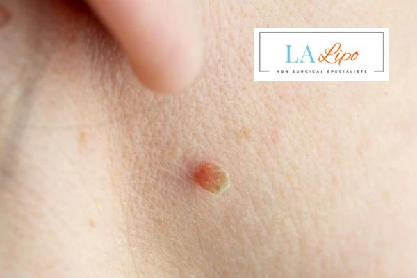 Book skin tag removal West Bromwich today speak to our team now!