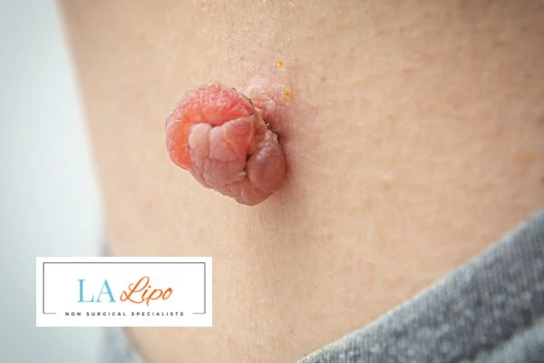 Interested in skin tag removal West Bromwich? Concerned about the pain? Find out more today!