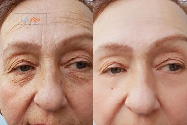The powerful benefits of Morpheus8 Treatment West Bromwich - Call Our team today!