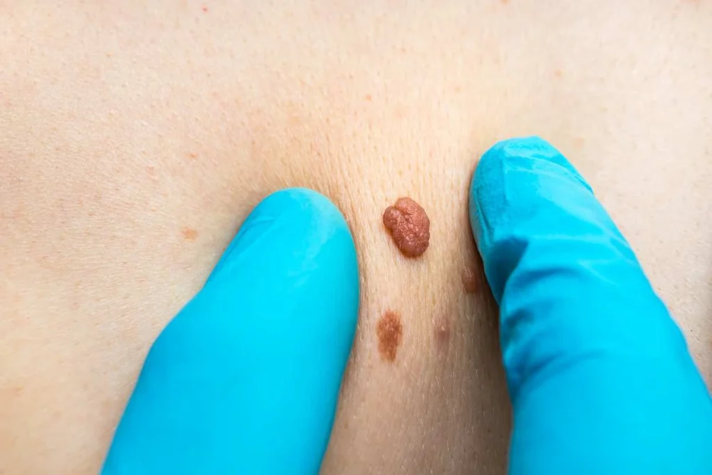 LA LIPO Cryopen Lesion Removal Prices West Bromwich