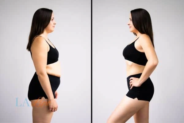Picture of womans before and after using LA-EMS body sculpting to improve her core strength West Bromwich