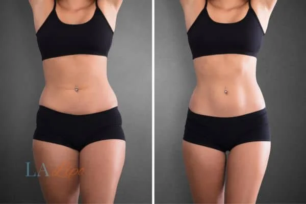 before and after results of non-surgical treatment to help a woman's body image and mental health West Bromwich