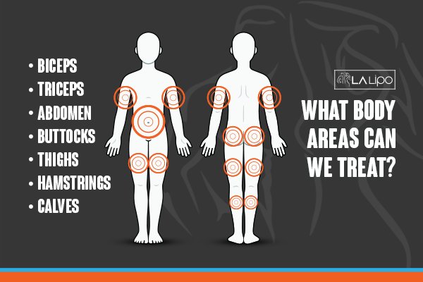 Diagram to show areas you can have LA-EMS Body Sculpting Treatment West Bromwich