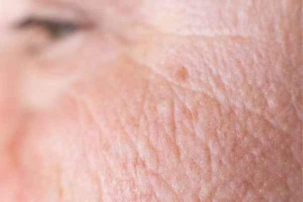 close up picture of a woman's face showing an age spot West Bromwich