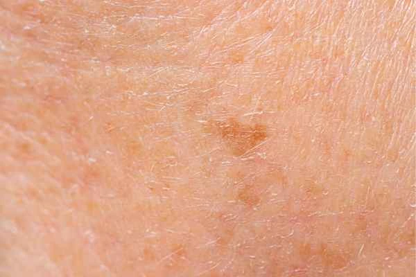 close up picture of age spots West Bromwich