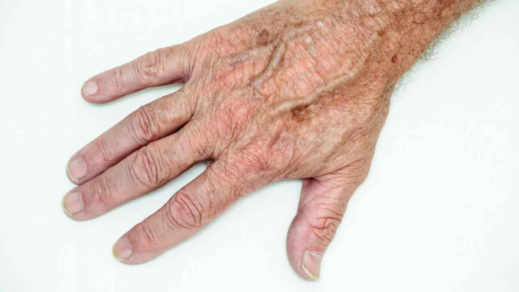 Male hand showing age spot West Bromwich