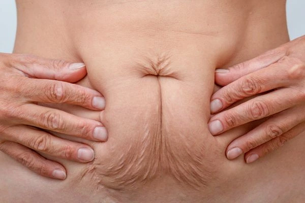 Image of a woman's stomach with loose skin - example of skin tightening West Bromwich options