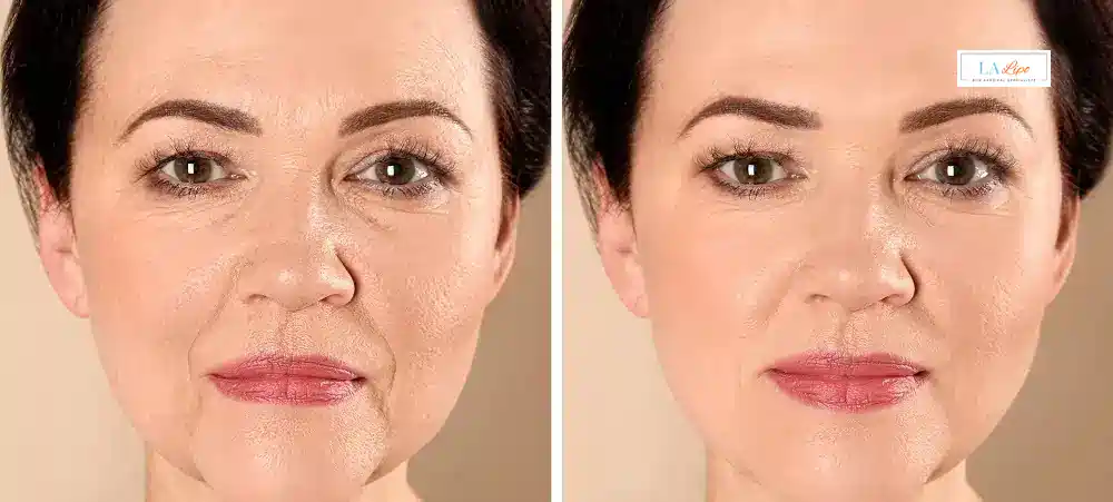How Long Does It Take to See Results and How Long Do They Last West Bromwich?