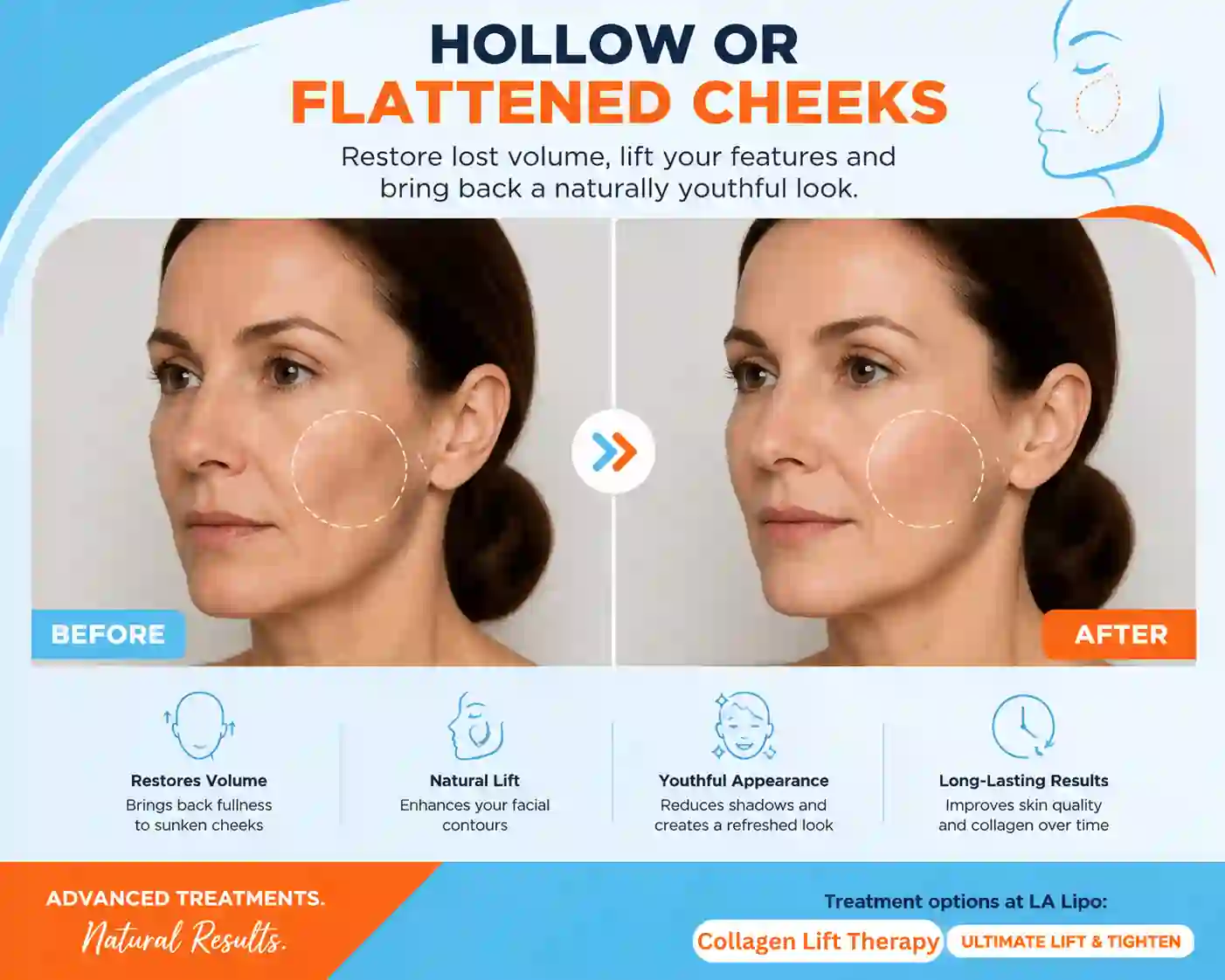 Sign #4: Hollow or Flattened Cheeks West Bromwich
