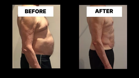 What Symptoms Can Diastasis Recti Cause in Men? Weak Core, Back Pain and Poor Posture West Bromwich